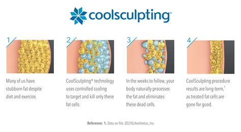 CoolSculpting® is a .